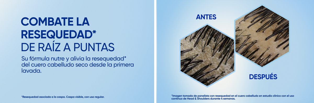 Comparativa antes y después de cuero cabelludo con resequedad sobre fondo azul claro, con texto "Combate la resequedad de raíz a puntas: Su fórmula nutre y alivia la resequedad del cuero cabelludo seco desde la primera lavada"