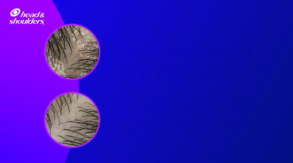 Imágenes de antes y después de cuero cabelludo con oleosidad sobre fondo azul, con texto "Tipo de Cabello: Diseñado para cuero cabelludo con oleosidad y caspa persistente*"