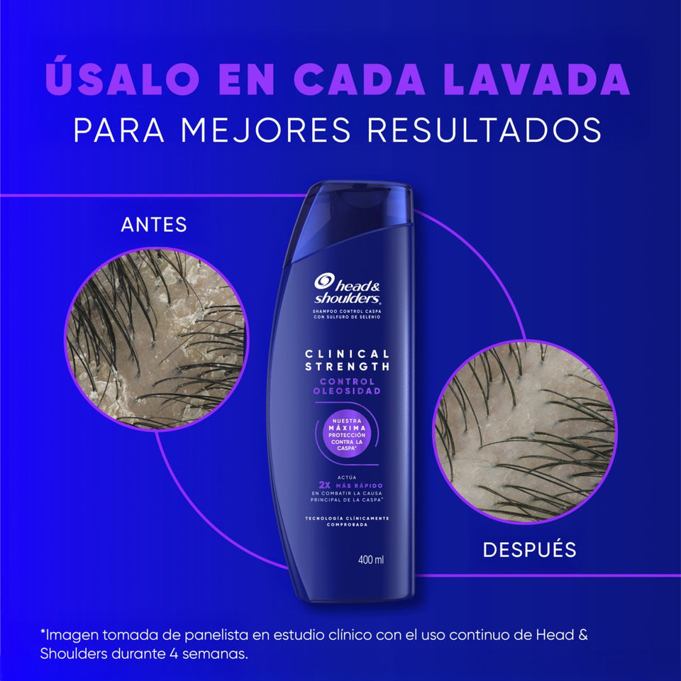 Imágenes de antes y después de cuero cabelludo junto a botella de Head & Shoulders Clinical Strength Control Oleosidad sobre fondo azul, con texto "Úsalo en Cada Lavada Para Mejores Resultados"