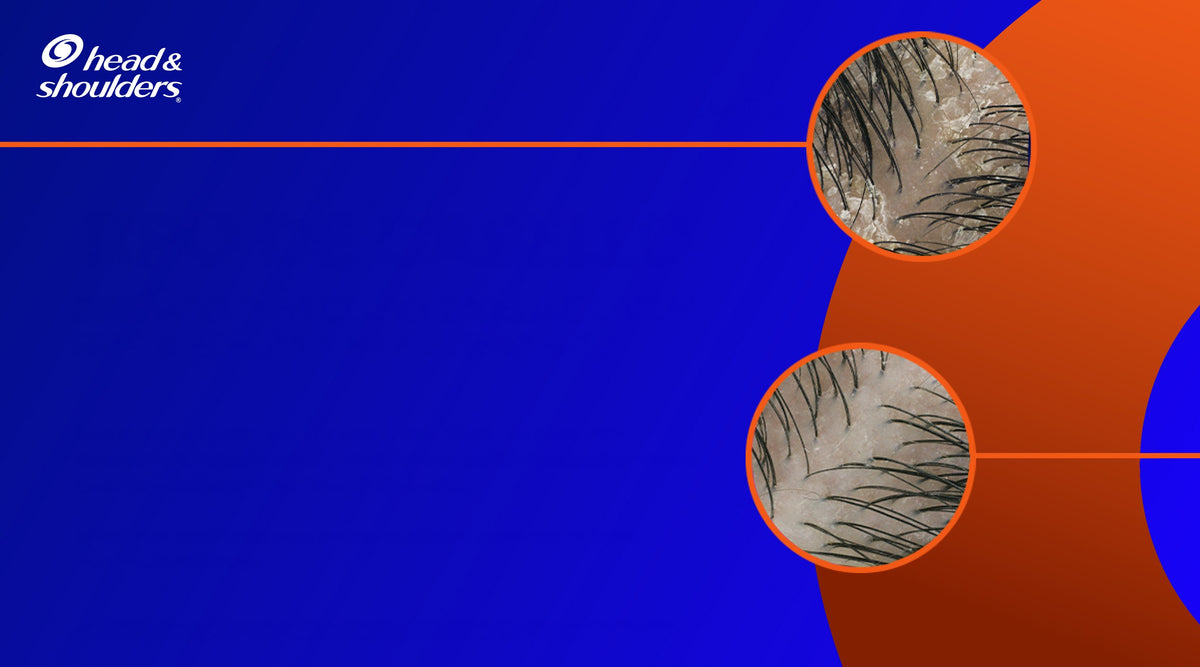 Imágenes de antes y después de cuero cabelludo con oleosidad sobre fondo azul, con texto "Tipo de Cabello: Diseñado para cuero cabelludo con resequedad¹ y caspa persistente*"